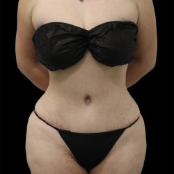 Tummy Tuck Before & After Patient #2786