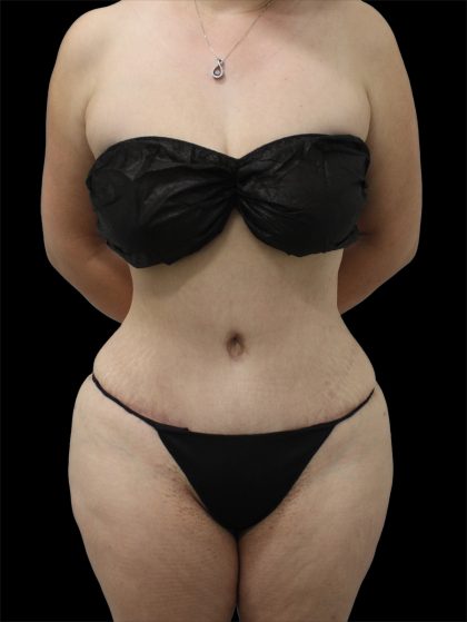 Tummy Tuck Before & After Patient #2786