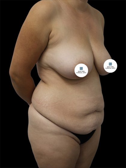 Tummy Tuck Before & After Patient #2786