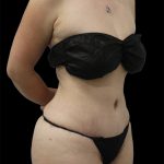 Tummy Tuck Before & After Patient #2786