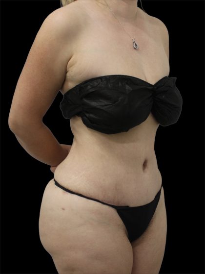 Tummy Tuck Before & After Patient #2786