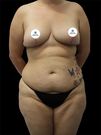 Tummy Tuck Before & After Patient #2787