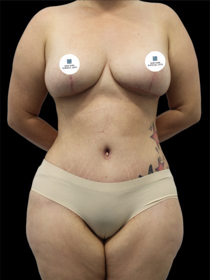 Tummy Tuck Before & After Patient #2787