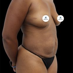Tummy Tuck Before & After Patient #2788
