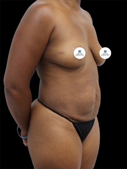 Tummy Tuck Before & After Patient #2788