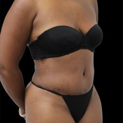 Tummy Tuck Before & After Patient #2788