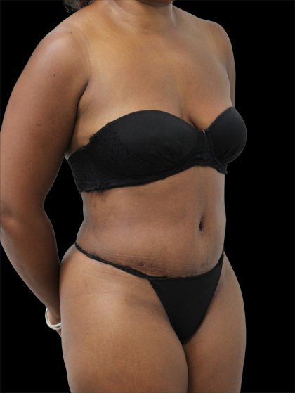Tummy Tuck Before & After Patient #2788