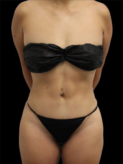 Tummy Tuck Before & After Patient #2789