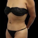 Tummy Tuck Before & After Patient #2789