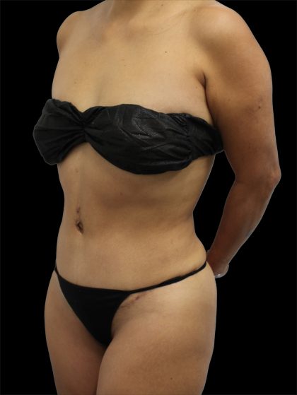 Tummy Tuck Before & After Patient #2789