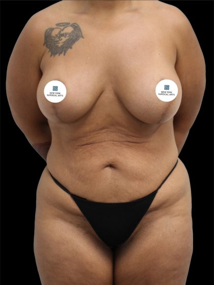 Tummy Tuck Before & After Patient #2790