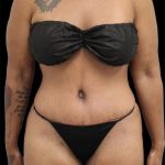 Tummy Tuck Before & After Patient #2790