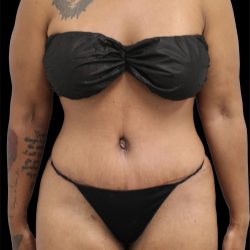 Tummy Tuck Before & After Patient #2790