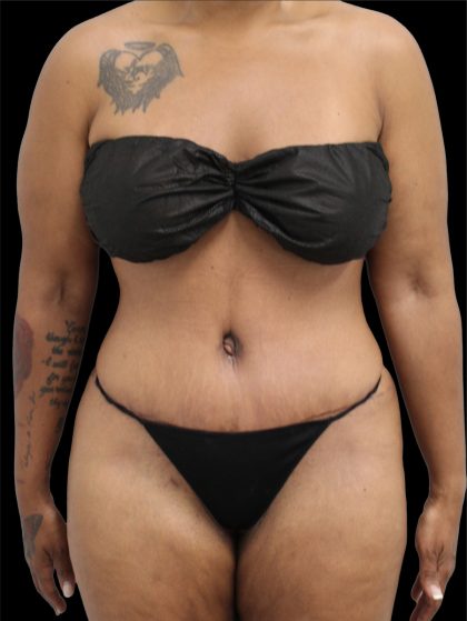Tummy Tuck Before & After Patient #2790