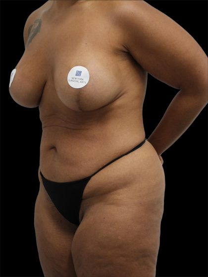Tummy Tuck Before & After Patient #2790