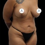 Tummy Tuck Before & After Patient #2790