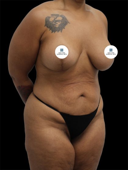 Tummy Tuck Before & After Patient #2790