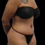 Tummy Tuck Before & After Patient #2790
