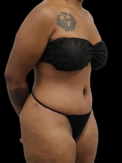 Tummy Tuck Before & After Patient #2790