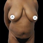 Tummy Tuck Before & After Patient #2791