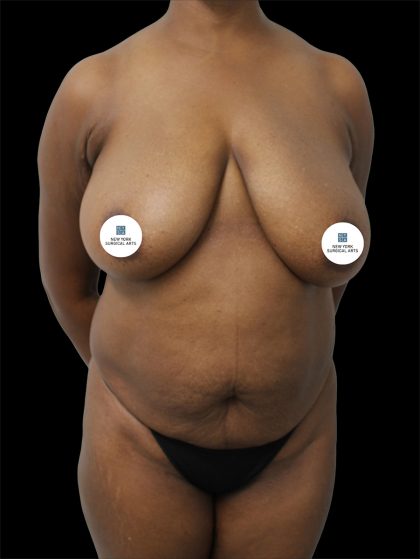 Tummy Tuck Before & After Patient #2791