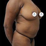 Tummy Tuck Before & After Patient #2791