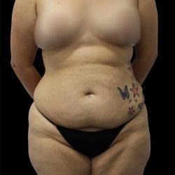 Tummy Tuck Before & After Patient #2689