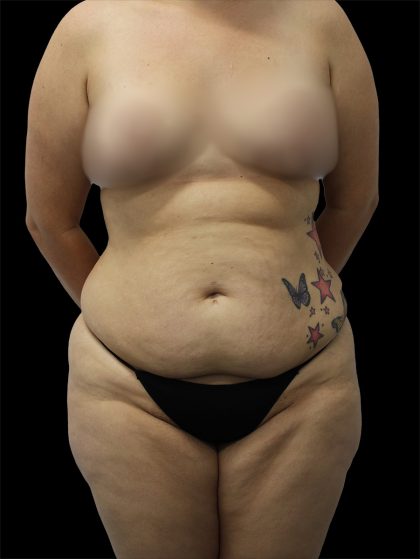 Tummy Tuck Before & After Patient #2689