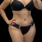 Tummy Tuck Before & After Patient #2689