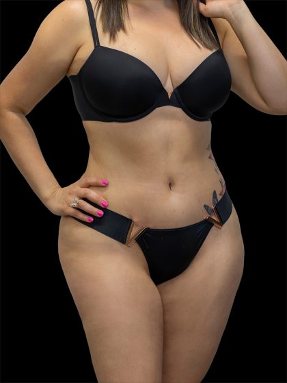 Tummy Tuck Before & After Patient #2689