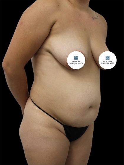 Tummy Tuck Before & After Patient #2792