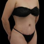 Tummy Tuck Before & After Patient #2792
