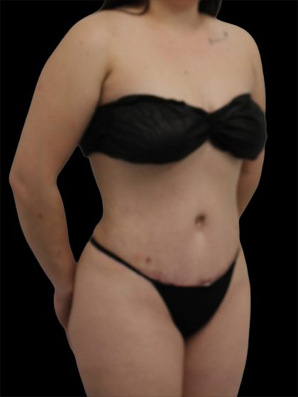 Tummy Tuck Before & After Patient #2792