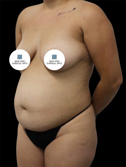 Tummy Tuck Before & After Patient #2792