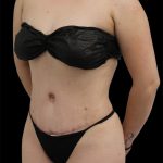Tummy Tuck Before & After Patient #2792