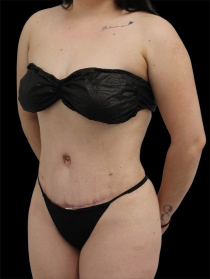 Tummy Tuck Before & After Patient #2792