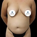 Tummy Tuck Before & After Patient #2792
