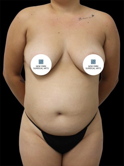 Tummy Tuck Before & After Patient #2792
