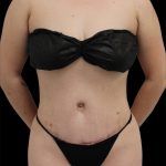 Tummy Tuck Before & After Patient #2792
