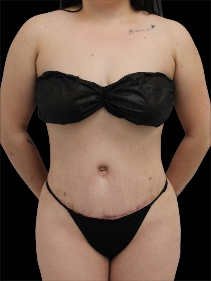 Tummy Tuck Before & After Patient #2792