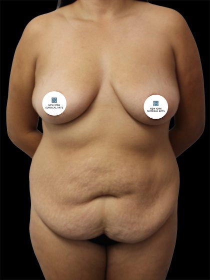 Tummy Tuck Before & After Patient #2837