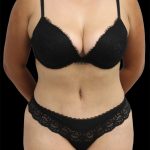 Tummy Tuck Before & After Patient #2837