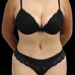 Tummy Tuck Before & After Patient #2837