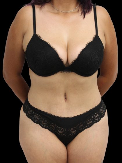 Tummy Tuck Before & After Patient #2837