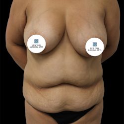 Tummy Tuck Before & After Patient #2838