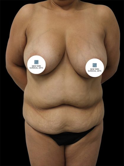 Tummy Tuck Before & After Patient #2838