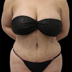 Tummy Tuck Before & After Patient #2838