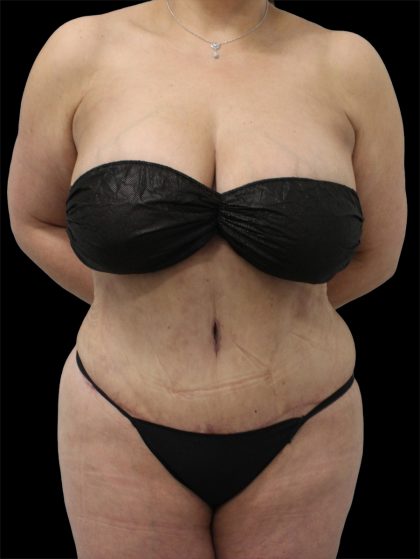 Tummy Tuck Before & After Patient #2838