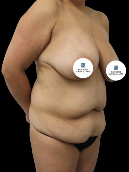 Tummy Tuck Before & After Patient #2838