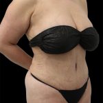 Tummy Tuck Before & After Patient #2838